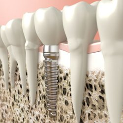Hopkin Oral Surgery - Hopkin Oral Surgery | Holladay, UT