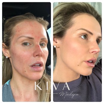 Kiva Medspa IV Lounge - Post Chemical Peel - Medical Spas Near Me - Orlando, Florida Kiva Medspa IV Lounge - Post Chemical Peel - Medical Spas Near Me - Orlando, Florida