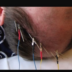 Mind and Body Acupuncture