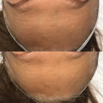 Smart Skin Solutions - Wow!!!! Forehead lines gone! Love the transformation! - Skin Care Near Me - Meridian, California Smart Skin Solutions - Wow!!!! Forehead lines gone! Love the transformation! - Skin Care Near Me - Meridian, California