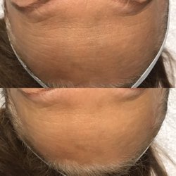 Smart Skin Solutions - Wow!!!! Forehead lines gone! Love the transformation!