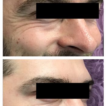 Renuvity Med Spa - Crow's Feet on a young man almost disappear after Botox - Medical Spas Near Me - Coppell, Texas Renuvity Med Spa - Crow's Feet on a young man almost disappear after Botox - Medical Spas Near Me - Coppell, Texas