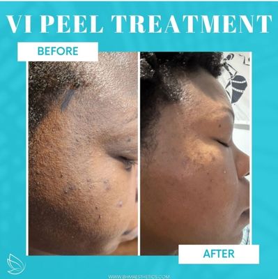VI Peel - Uniquely crafted to treat all skin types and tones! A medium depth chemical peel that utilizes TCA, retinoic acid, salicylic acid, vitamin C, and phenol to exfoliate the skin and reveal the smoother, brighter, less damaged layers of the skin underneath.
Chemical peels have been performed for decades to reveal healthier, brighter skin. Less aggressive than a deep peel, it improves the appearance of aging and damaged skin in as little as one treatment. It is safe for ALL skin types and tones. VI Peel - Uniquely crafted to treat all skin types and tones! A medium depth chemical peel that utilizes TCA, retinoic acid, salicylic acid, vitamin C, and phenol to exfoliate the skin and reveal the smoother, brighter, less damaged layers of the skin underneath.
Chemical peels have been performed for decades to reveal healthier, brighter skin. Less aggressive than a deep peel, it improves the appearance of aging and damaged skin in as little as one treatment. It is safe for ALL skin types and tones.