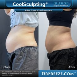 Dr. Freeze CoolSculpting Center