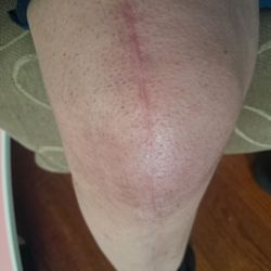 This is what happens after at Twin Boro PT. My knee is sore but for good reason.