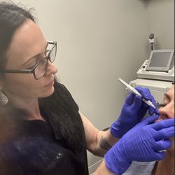 Alchemy Aesthetics - Dermal Filler injection to pyriform space correcting volume loss