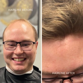 Nuhairlines - Men's hair replacement. Natural hairline - Hair Loss Centers Near Me - Scottsdale, Arizona Nuhairlines - Men's hair replacement. Natural hairline - Hair Loss Centers Near Me - Scottsdale, Arizona