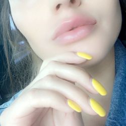Ideal Image Cincinnati -West Chester - Lip Filler