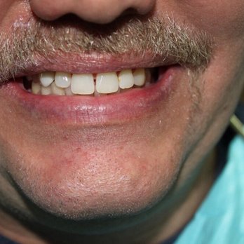 Pine Plaza Dental - Before - Cosmetic Dentists Near Me - Las Vegas, Nevada Pine Plaza Dental - Before - Cosmetic Dentists Near Me - Las Vegas, Nevada