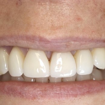 Burbank Periodontics - "Before"
Before tooth extraction and same day implant/temporary crown placement.
Pic 1/3 - Periodontists Near Me - Burbank, California Burbank Periodontics - "Before"
Before tooth extraction and same day implant/temporary crown placement.
Pic 1/3 - Periodontists Near Me - Burbank, California