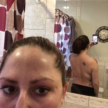 Rhee Plastic Surgery - This was the result of the cool sculpting(done elsewhere) it had a weird side effect that made my fat grow. - Plastic Surgeons Near Me - Paramus, New Jersey