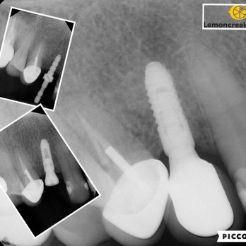 Lemoncreek Dental - Dental implant- a conservative way to replace missing teeth where we don't have to grind on the adjacent teeth! - Cosmetic Dentists Near Me - Walnut, California Lemoncreek Dental - Dental implant- a conservative way to replace missing teeth where we don't have to grind on the adjacent teeth! - Cosmetic Dentists Near Me - Walnut, California