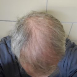 Bosley Hair Restoration & Transplant