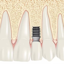Implant Dentistry of Northshore - Single dental implant