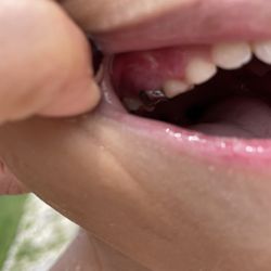Champions Pediatric Dentistry - Spring - The dentist Dr. Shannon Deveras in her notes stated it was self inflicted which is a lie. I have recordings as well.