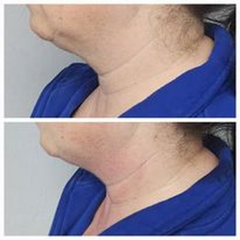 Simply Sculpted - Body Contouring Near Me - Oakdale, Pennsylvania Simply Sculpted - Body Contouring Near Me - Oakdale, Pennsylvania