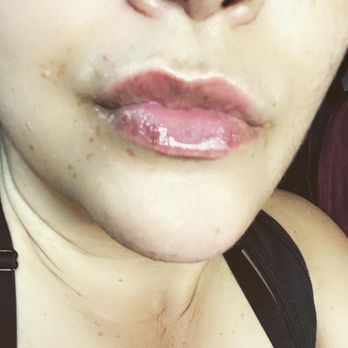 Exotic Enhancements - Before lip filler - Teeth Whitening Near Me - Irmo, South Carolina Exotic Enhancements - Before lip filler - Teeth Whitening Near Me - Irmo, South Carolina