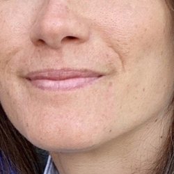 The Ageless Center - Before lip filler