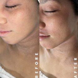 Kairopractic Skin - DMK Enzyme Treatment to help nourish & heal the skin during Topical Steroid Withdrawal.