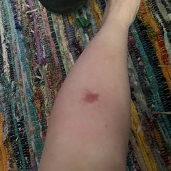Riverside Medical Clinic Urgent Care Center - Spider bite.... Told me if I waited longer I would've developed cellulitis a skin infection... glad they are open