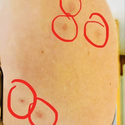 Quality Inn & Suites - Bite marks from bedbugs