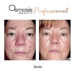 Bella's Healthy Living - Acne before and after