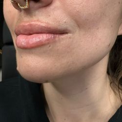 Honest Medspa - Post lip filler treatment with RHA2 - 1 ml syringe.