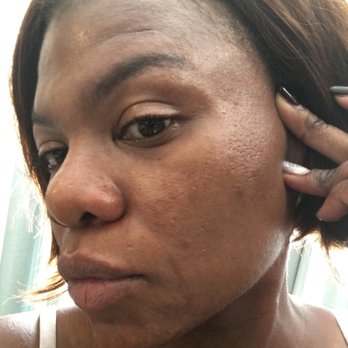 Derm by Erica - September 2017 - Skin Care Near Me - Culver City, California