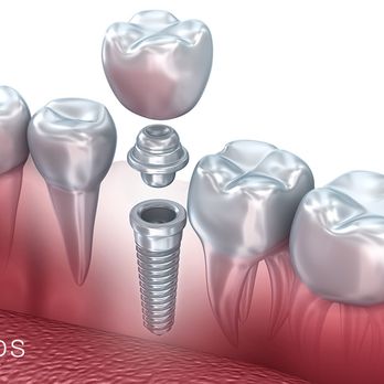 Barsky DDS - Dental implant at Barsky DDS - Cosmetic Dentists Near Me - Miami, Florida Barsky DDS - Dental implant at Barsky DDS - Cosmetic Dentists Near Me - Miami, Florida