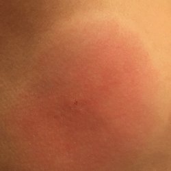 Catherine R. Manuel, MD - Day after spider bite