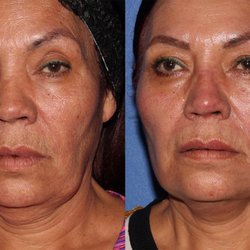 Perfect Skin Center - Tempe - FaceTite