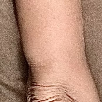 Wright Surgical Arts - Fat bump right before the elbow - Medical Spas Near Me - Pasco, Washington Wright Surgical Arts - Fat bump right before the elbow - Medical Spas Near Me - Pasco, Washington
