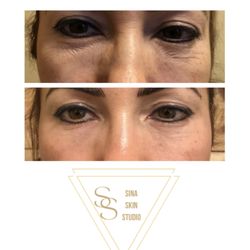 Sina Skin Studio - Microneedling Result after ONE Session