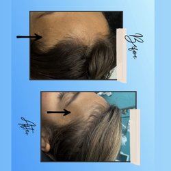 Aesthetics Care Med Spa - After 3 sessions of hair PRP sessions