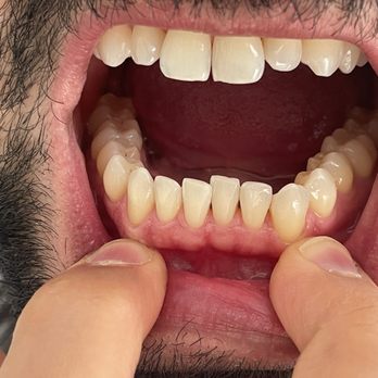 Joseph Goodman, DDS, DMD - Minoo cleaned all the build up - thank u - General Dentistry Near Me - Beverly Hills, California Joseph Goodman, DDS, DMD - Minoo cleaned all the build up - thank u - General Dentistry Near Me - Beverly Hills, California