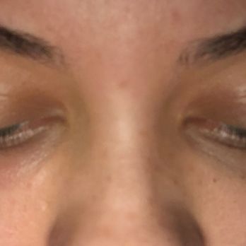 DermFx - 6 months after under eye filler, right eye suddenly bruised and swollen. December 2018 - Medical Spas Near Me - Redondo Beach, California DermFx - 6 months after under eye filler, right eye suddenly bruised and swollen. December 2018 - Medical Spas Near Me - Redondo Beach, California