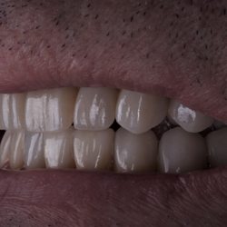 Buie Clinic- Advanced Dental Implants and Prosthetics - Complex and Comprehensive care from a specialist is required for an outcome that will last many years.