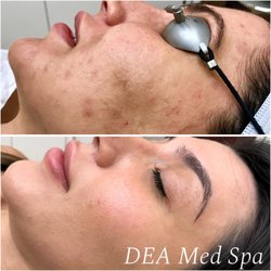 DEA Med Spa - IPL Photo Facial