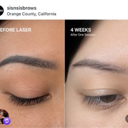 Laser eyebrow tattoo removal here at SIS & SIS.  This is just the first session 4 week in. Results vary per person