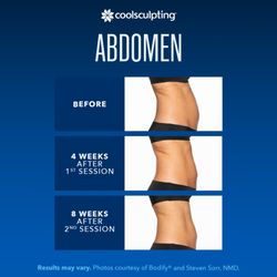 The Spa Boutique CoolSculpting of Trinity - CoolSculpting is your answer to permanent stubborn fat removal! Call for a free consult.