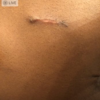 Joshua B Hyman, MD - Scar Revision from myomectomy. this looks more like a stab wound and worse than the original scar - Cosmetic Surgeons Near Me - New York, New York