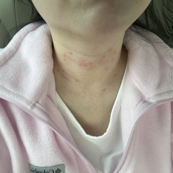 Eterna Aesthetic - Right after burning off extra skin from my neck by Jesse. Don't be scared! It will heal! Numbing cream was used. - Medical Spas Near Me - Rosemead, California Eterna Aesthetic - Right after burning off extra skin from my neck by Jesse. Don't be scared! It will heal! Numbing cream was used. - Medical Spas Near Me - Rosemead, California