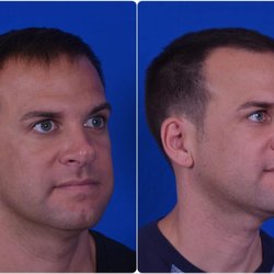 Dilworth Facial Plastic Surgery