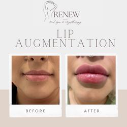 Renew Med Spa & Cryotherapy - Lip Augmentation Before and After