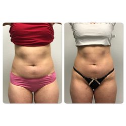 The Lipo Lounge - Lose inches now!