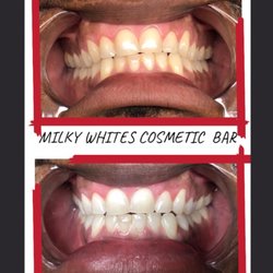 Milky Whites Cosmetic Bar - 30 minute Express treatment