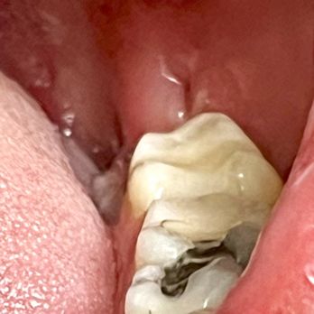 Wisdom Teeth - The bone sticking out was cutting my son's tongue.  I called into the office.  Pull it out with tweezers or plyers I was told. - General Dentistry Near Me - Murray, Utah