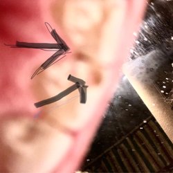 The Tooth Place - This tooth number 8 which had these 2 drill holes no fillings, which proceeded to make tooth crumble