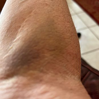 Pima Pain Center - Bruise from attempting IV. Blew the vein up. - Pain Management Near Me - Tucson, Arizona Pima Pain Center - Bruise from attempting IV. Blew the vein up. - Pain Management Near Me - Tucson, Arizona