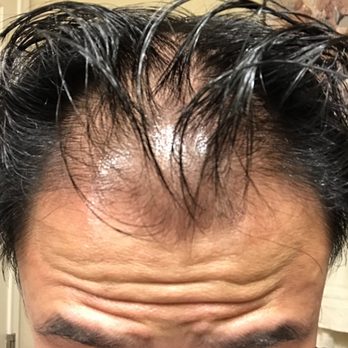 Scalp Symmetry - Scalp Micropigmentation - Before Photo - Hair Loss Centers Near Me - La Jolla, California Scalp Symmetry - Scalp Micropigmentation - Before Photo - Hair Loss Centers Near Me - La Jolla, California